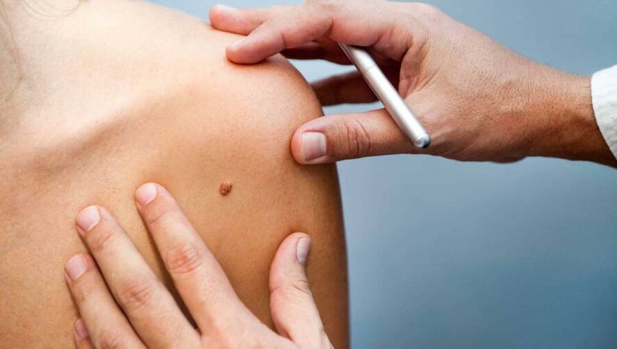 Dermatolog badający pacjenta z brodawczakiem