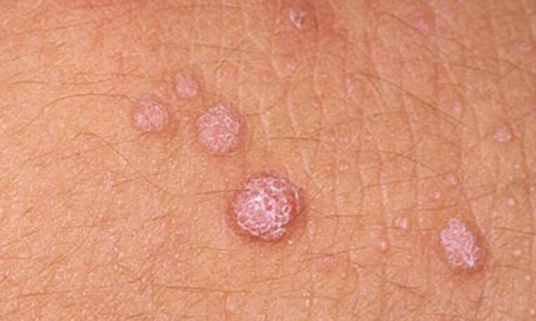 HPV prowadzi do pojawienia się brodawczaków skórnych