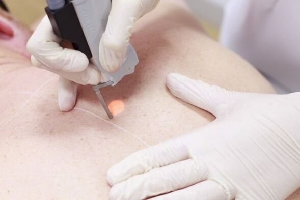 Popularna metoda usuwania brodawczaków za pomocą lasera