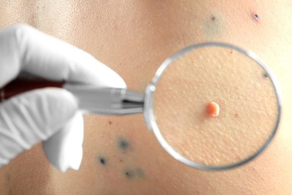 Leczenie HPV