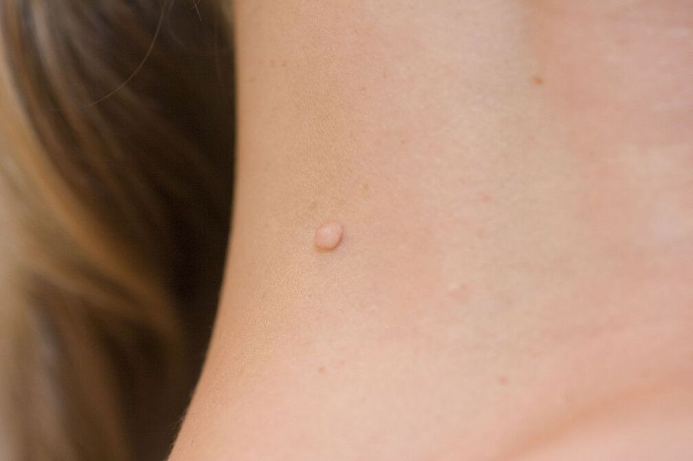 Objawy HPV
